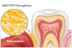 periodontal-gum-disease-treatment-2