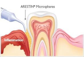 periodontal-gum-disease-treatment